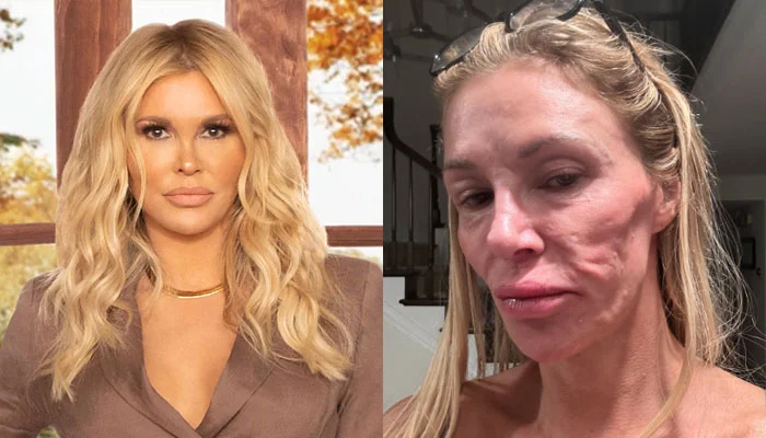 Brandi Glanville Offers Hopeful Update on Mysterious Skin Condition